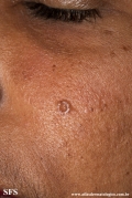 trichoepithelioma dermoplastic