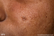 trichoepithelioma dermoplastic