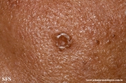 trichoepithelioma dermoplastic