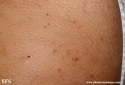 cutaneous_necrosis-topical_potassium_permanganate