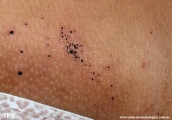 cutaneous_necrosis-topical_potassium_permanganate