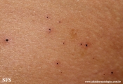cutaneous_necrosis-topical_potassium_permanganate