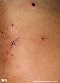 cutaneous_necrosis-topical_potassium_permanganate