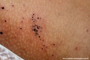 cutaneous_necrosis-topical_potassium_permanganate