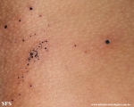cutaneous_necrosis-topical_potassium_permanganate