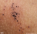 cutaneous_necrosis-topical_potassium_permanganate
