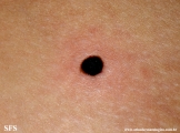 cutaneous_necrosis-topical_potassium_permanganate