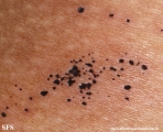 cutaneous_necrosis-topical_potassium_permanganate