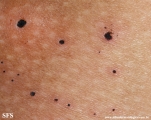 cutaneous_necrosis-topical_potassium_permanganate