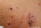 cutaneous_necrosis-topical_potassium_permanganate