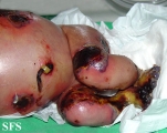 epidermolysis bullosa and pseudomonas infection