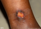 martorell's ulcer