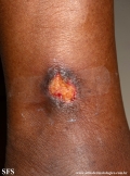 martorell's ulcer