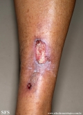 martorell's ulcer