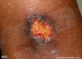 martorell's ulcer