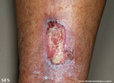 martorell's ulcer