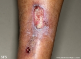 martorell's ulcer