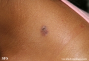 dermatofibroma-atrophic_dermatofibroma
