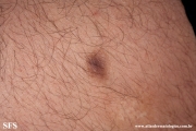dermatofibroma-atrophic_dermatofibroma