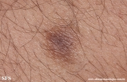 dermatofibroma-atrophic_dermatofibroma