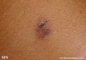 dermatofibroma-atrophic_dermatofibroma