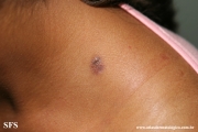 dermatofibroma-atrophic_dermatofibroma
