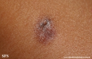 dermatofibroma-atrophic_dermatofibroma