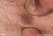 dermatofibroma-atrophic_dermatofibroma