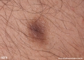 dermatofibroma-atrophic_dermatofibroma