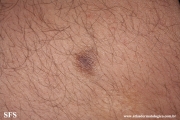 dermatofibroma-atrophic_dermatofibroma