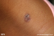dermatofibroma-atrophic_dermatofibroma