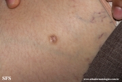 dermatofibroma-atrophic_dermatofibroma