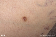 dermatofibroma-atrophic_dermatofibroma