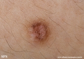 dermatofibroma-atrophic_dermatofibroma