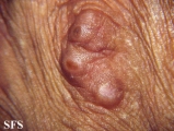 erythema elevatum diutinum