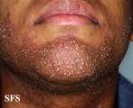 folliculitis of barbae