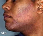folliculitis of barbae
