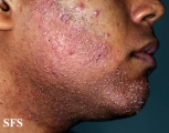 folliculitis of barbae