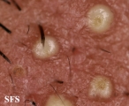 folliculitis of barbae