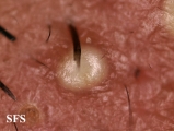 folliculitis of barbae