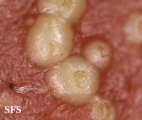 folliculitis of barbae