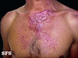 lupus erythematosus chronicus disseminatus superficialis
