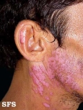 lupus erythematosus chronicus disseminatus superficialis
