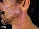 lupus erythematosus chronicus disseminatus superficialis