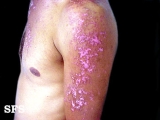 lupus erythematosus chronicus disseminatus superficialis