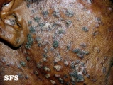 lupus erythematosus chronicus disseminatus superficialis