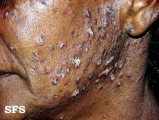 lupus erythematosus chronicus disseminatus superficialis