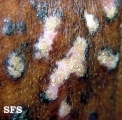 lupus erythematosus chronicus disseminatus superficialis