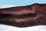 lupus erythematosus chronicus disseminatus superficialis
