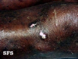 lupus erythematosus chronicus disseminatus superficialis